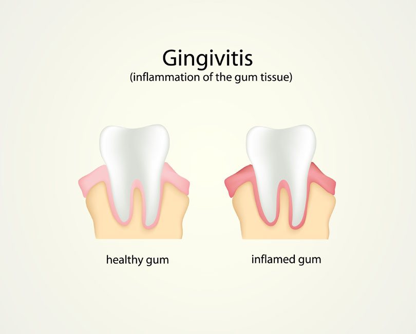 gingivtis